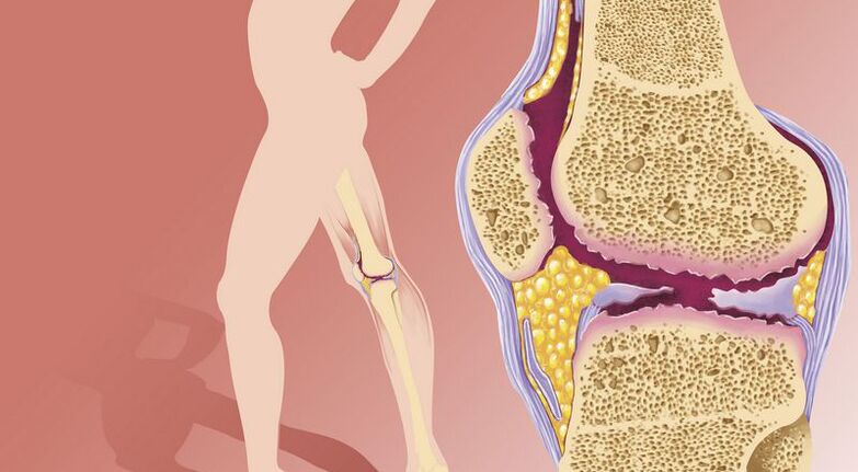 sobra nga gibug-aton modala ngadto sa arthrosis