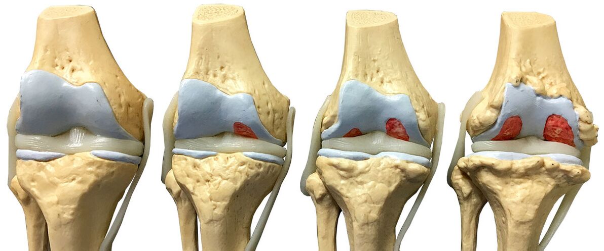 Mga yugto sa Arthrosis