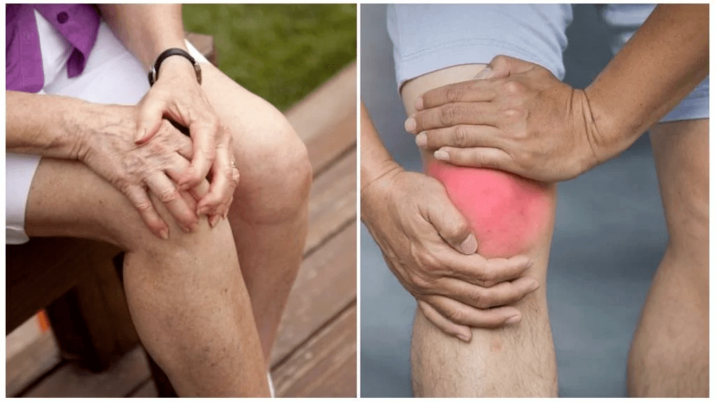 Pagtambal sa Arthrosis