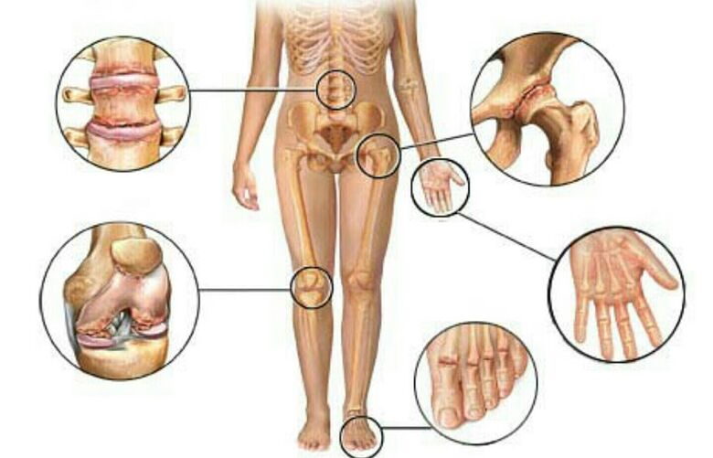 Mga tipo ug degree sa Arthrosis